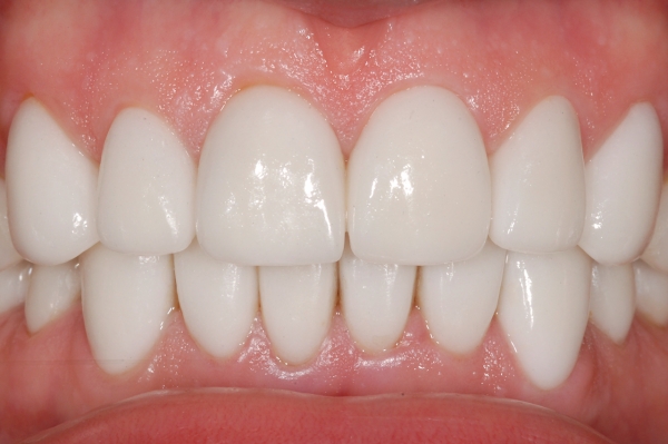 Восстановление фронтальной группы зубов  в прямой технике