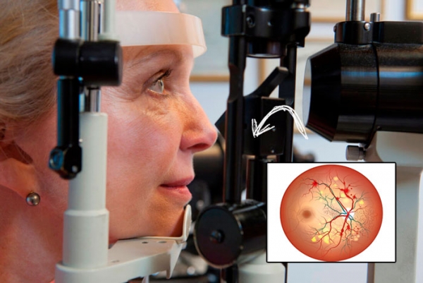 Тромбоз центральной вены сетчатки: диагностические, лечебные, реабилитационные аспекты ведения пациента