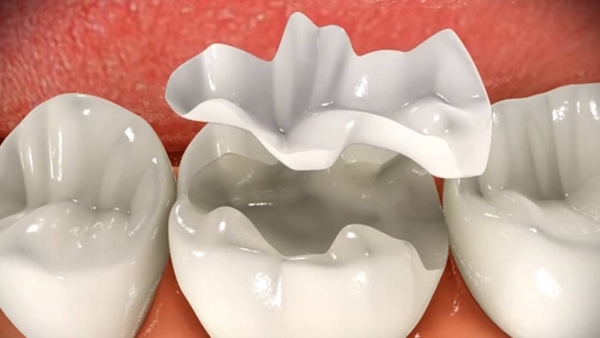 Концепция восстановления жевательной группы зубов композитными материалами